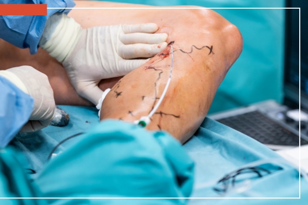 cirugia laser varices tiene bajo riesgo de complicaciones