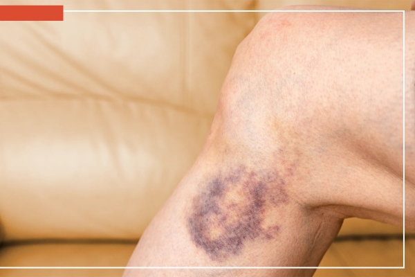 manchas oscuras por varices